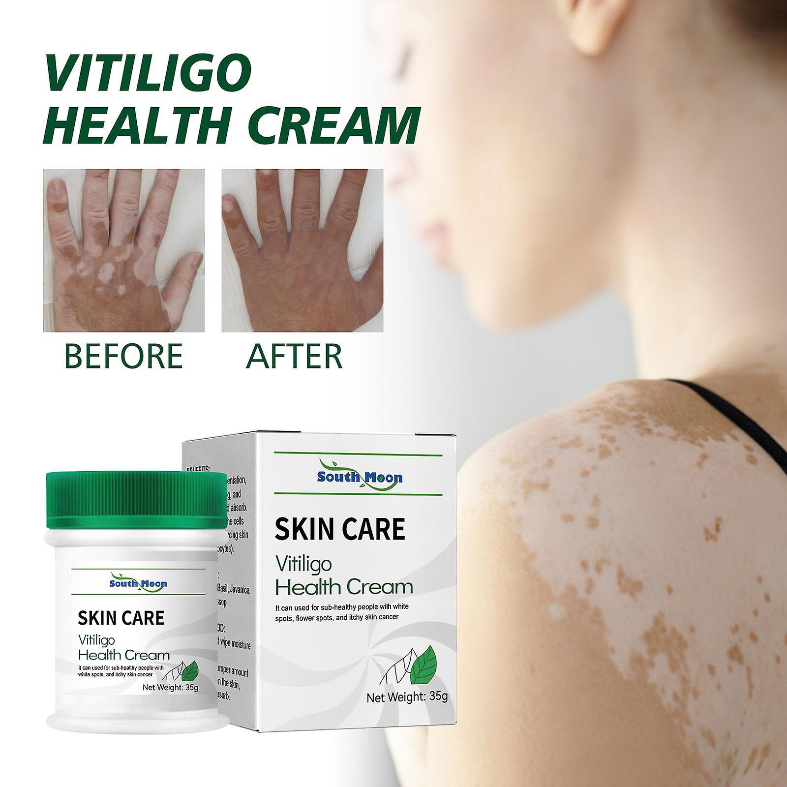 Hongyexin White Vitiligo Cream Cream Psoriasis Localized Vitiligo Ointment Mycosis Leukoplakia