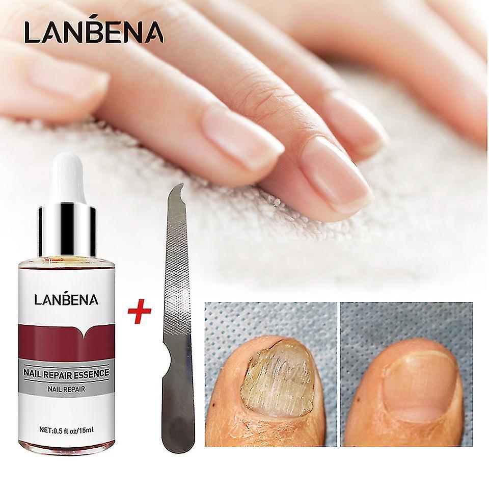 Unitoney Lanbena - Essence Of Repair Of Antifungal Nails, Treatment Serum, Elimination Of Fungi From Nails From The Feet, Hands, Toes, Anti Paronyc...