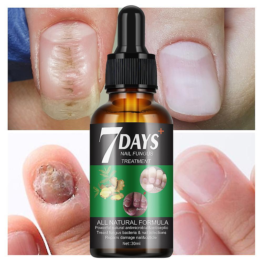 Frusde 7 Days Nail Fungus Treatment, 7 Days Nail Growth and Strengthening Serum Nail, Nail Repair Solution, Restoring Healthy Nails 3pcs