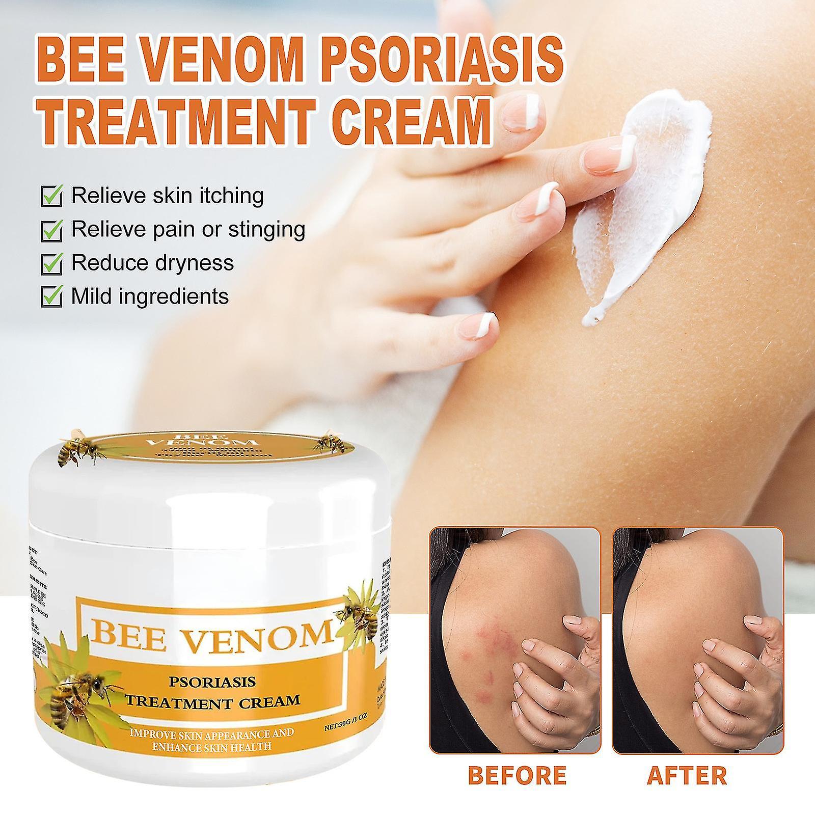 Sunset Bee Venom Psoriasis Treatment Cream, New Zealand Bee Venom Professional Psoriasis Treatment Cream, Soothing Moisturizing Psoriasis Cream 3pcs