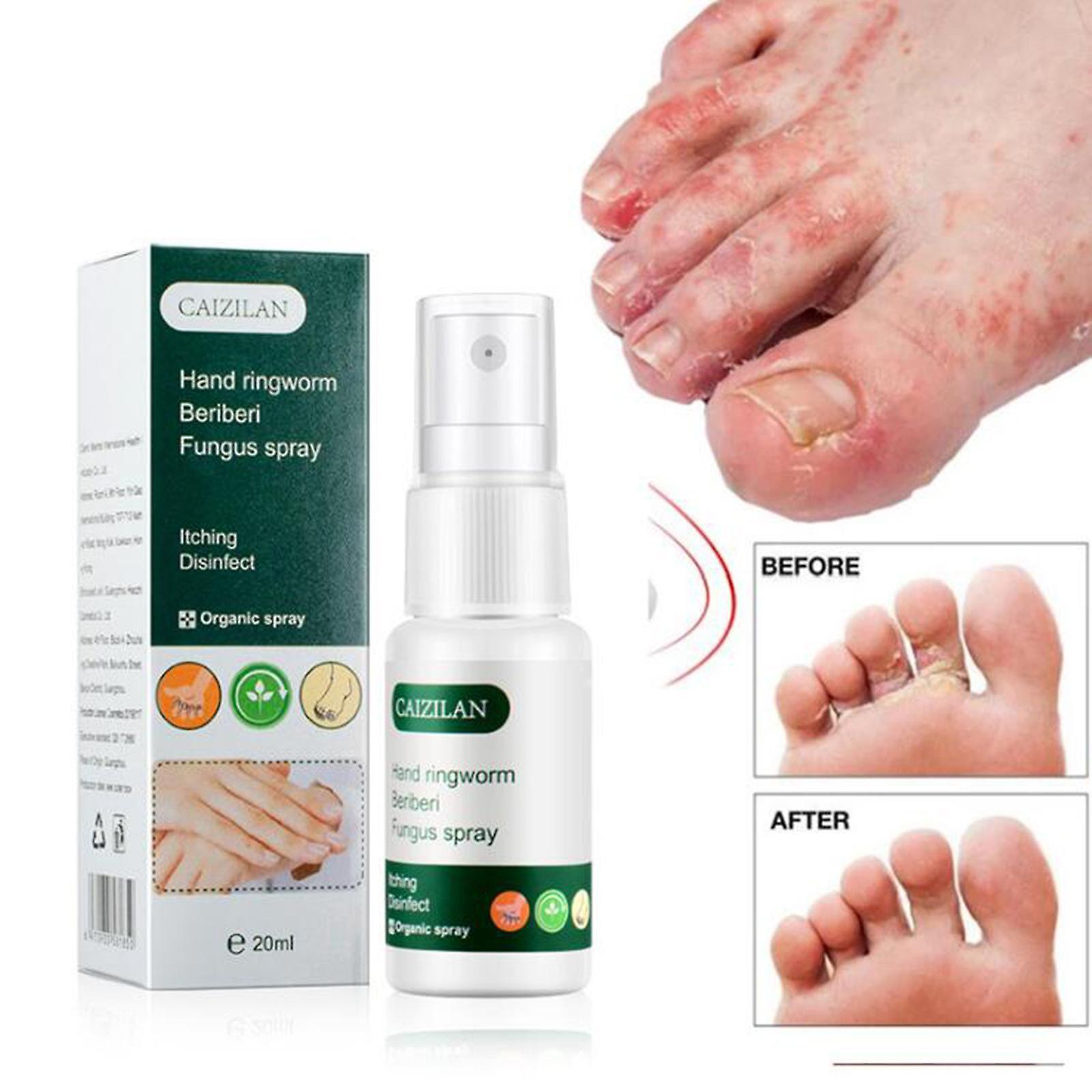 unbrand Caizilan Hand And Foot Skin Spray Hand And Foot Spray 20ml A