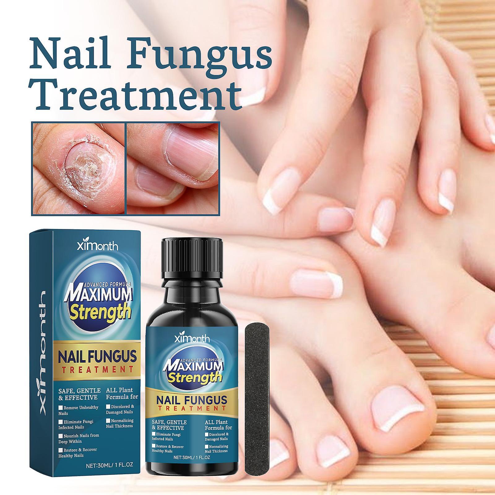 Frusde Nail Fungus Treatment for Toenails, Toe Nail Fungus Treatment, Extra Strength Nail Fungus Treatment, Toenail Fungus Treatment 1pcs