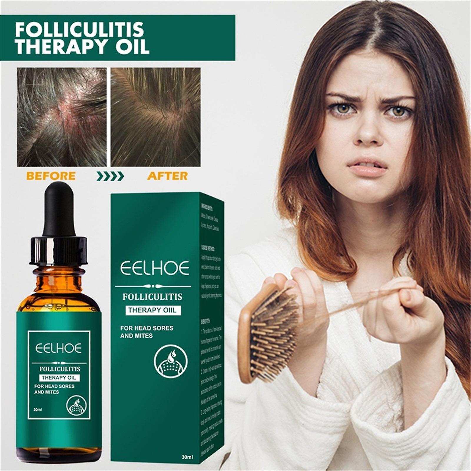 Baodan Scalp Folliculitis Oil, Scalp Hair Oil, Natural Hair And Scalp Oil, Nourishing For Split Ends And Dry Scalp For All Hair Types 30ml