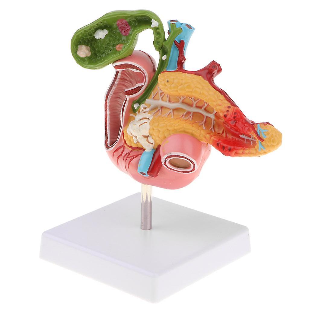 JoYoung Shop 1:1 Life Size Anatomical Human Pancreas Duodenum Gallbladder Pathology Model, Lab Office Equipment Ornament For Students