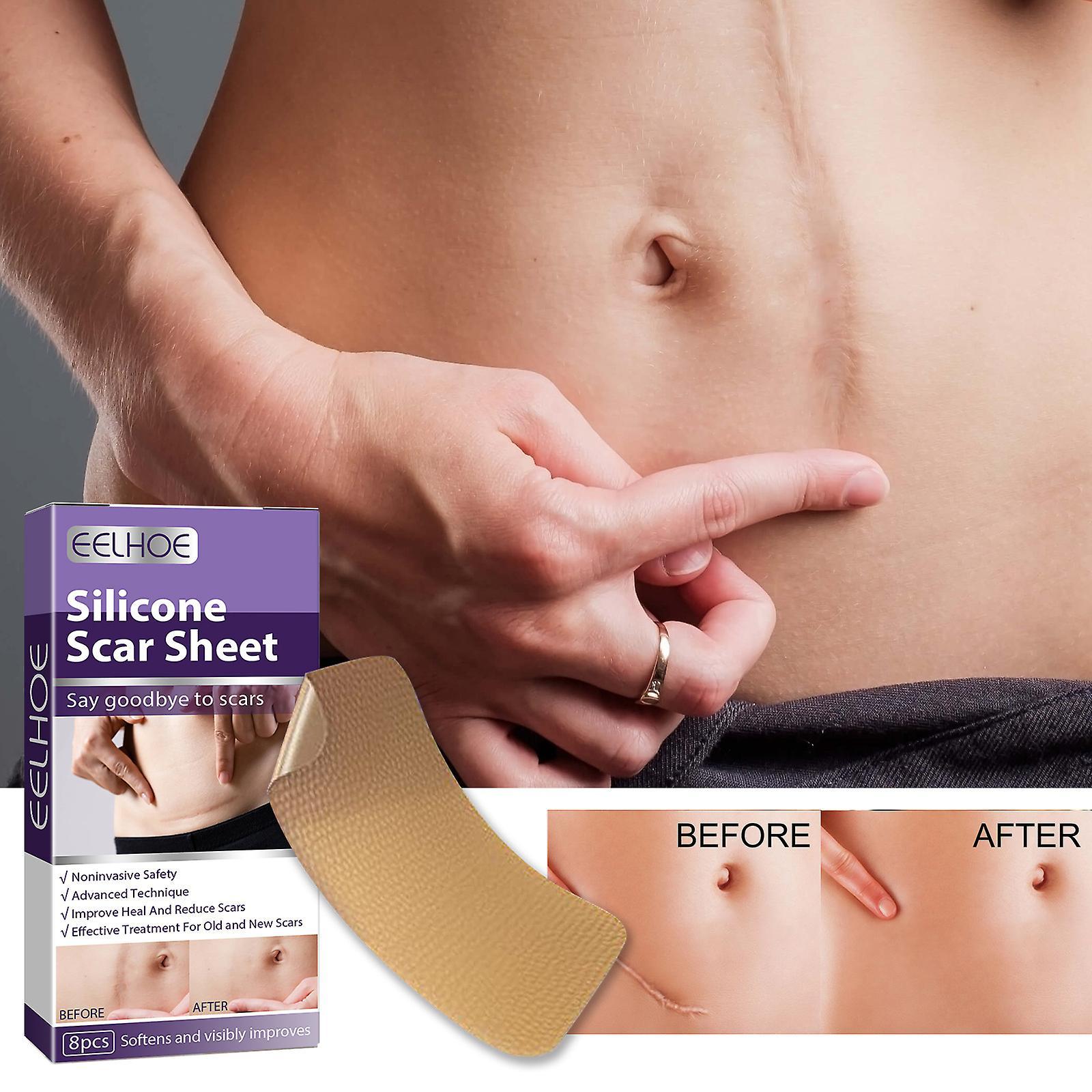 Antbaba Silicone Scar Sheets, Silicone Scar Strips, Effective Scars Away, Invisible Silicone Scar Sheets Tattoo Cover Up Tape Scar Removal Sheets 2...