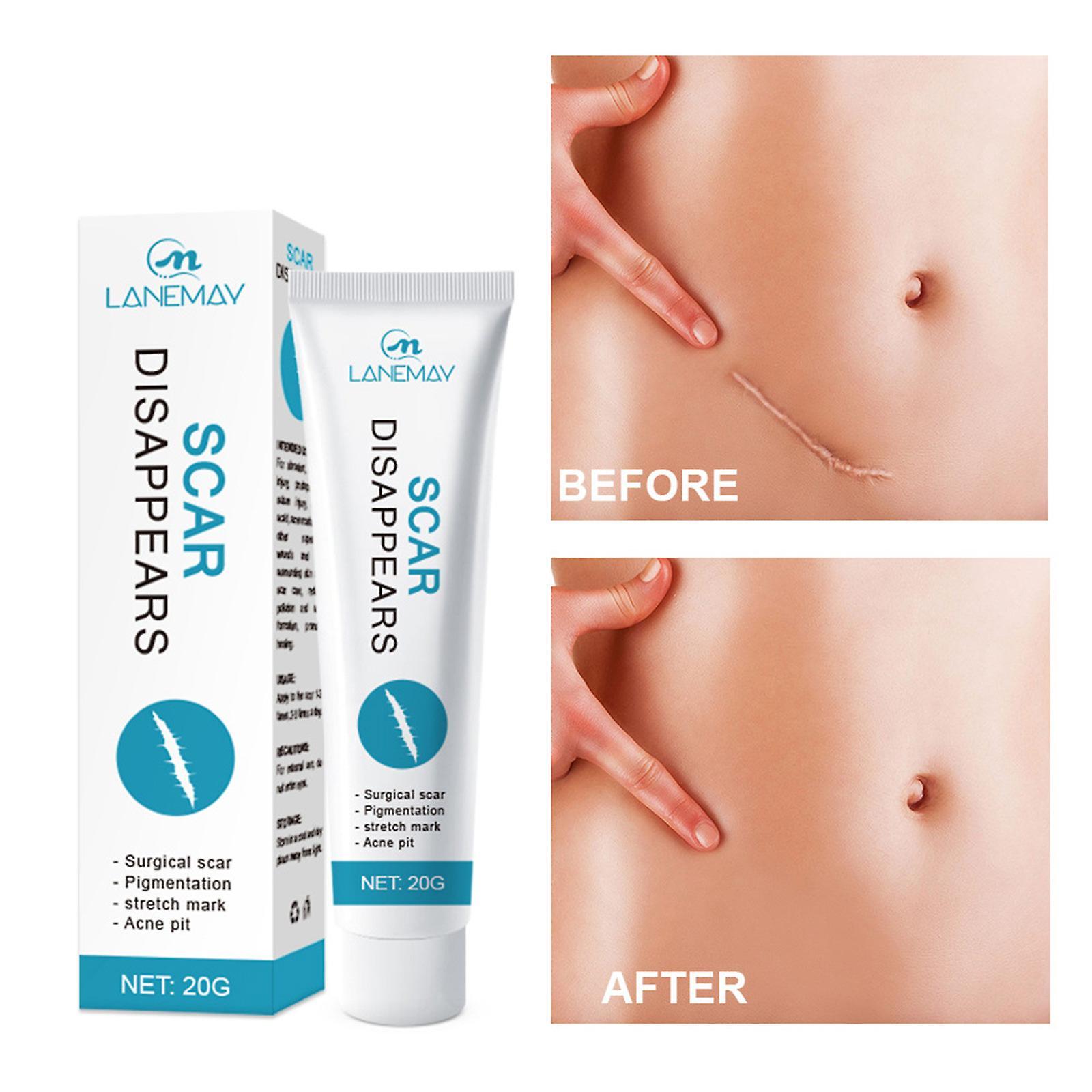 Flye Go Scar Removal Gel For Keloids, Removing Scar Repair Cream Fade Scar Smooth Repair Cream White