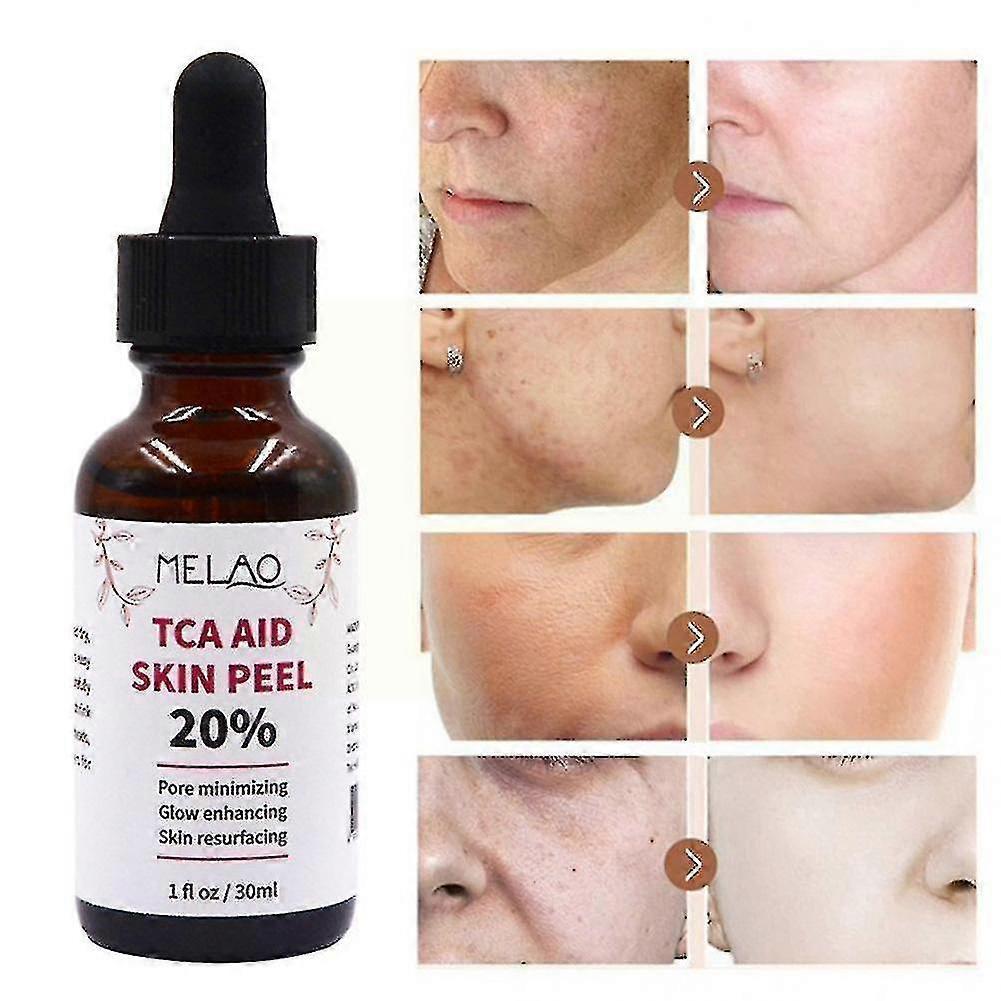 30ml Tca D2t1 20% Tloroacetic Anti- Skin Serum Facial Care Skin Care #YoGu