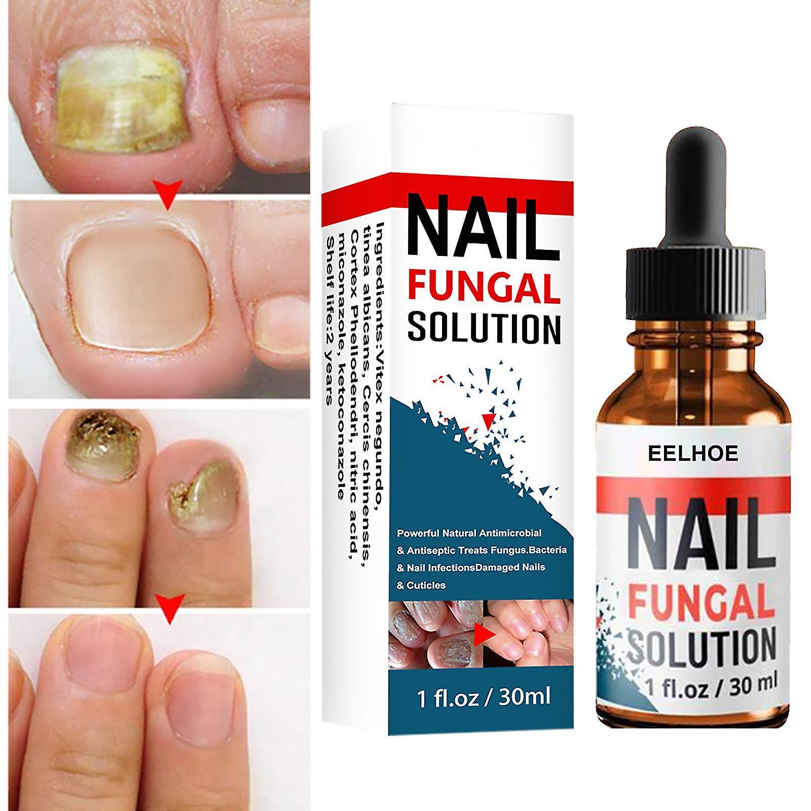 Jnnjv Nail Fungal Solution, Extra Strong Toenail Fungus Nail Treatment, Fungus Fingernail & Toenail Solution To Renew Damaged Discoloured Toenail