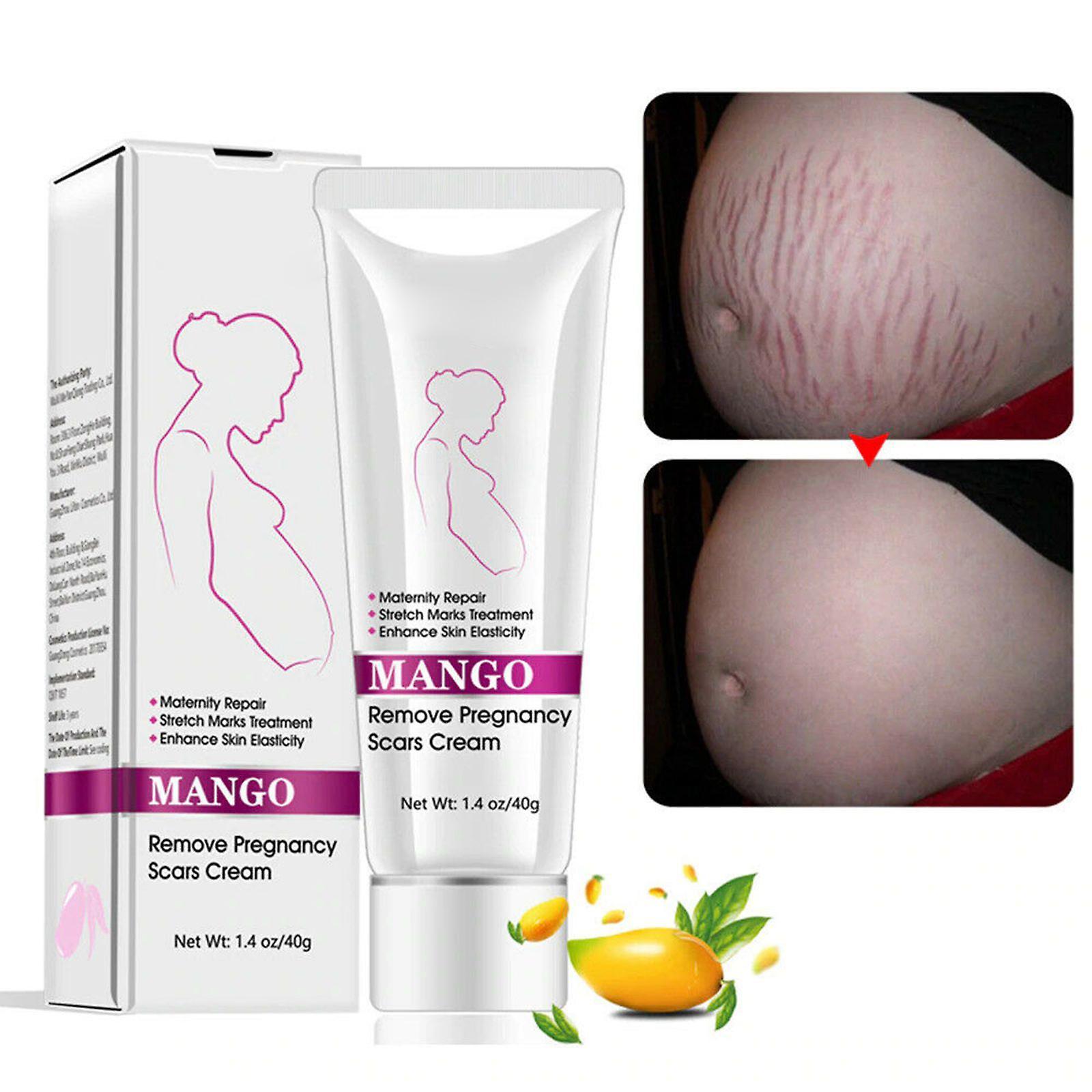 Woyaz Sofirn Mango Remove Pregnancy Scars Acne Cream Stretch Marks Treatment Maternity Repair Anti-aging Anti-winkles Firming Body Creams Md1  PLAY