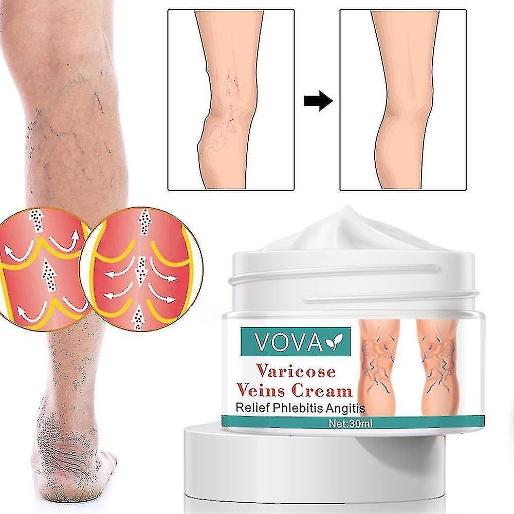 Wavepig 30ml Vova Varicose Vein Cream, Anti-varicose Veins,varicose Veins,varicose Veintreatment,varicose Cream Anti-heavy Tired Legs, Relieves Varico