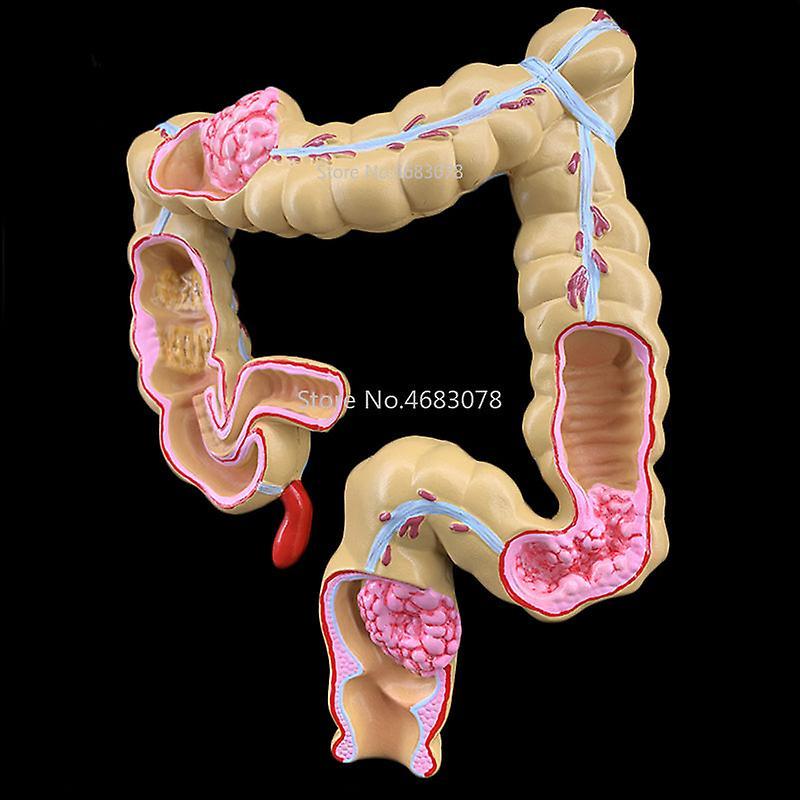 JoYoung Shop Colorectal Lesion Model Human Colon Large Intestine Pathological Diseases Model Medical Organizer Anatomy 14x17x21cm