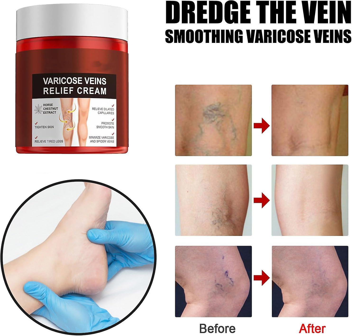 Lelinker Varicose Veins Relief Cream, Varicose Vein Cream For Legs Reduces Spider Veins,varicose Veins Relief For Legs, Strengthen Capillary Health...