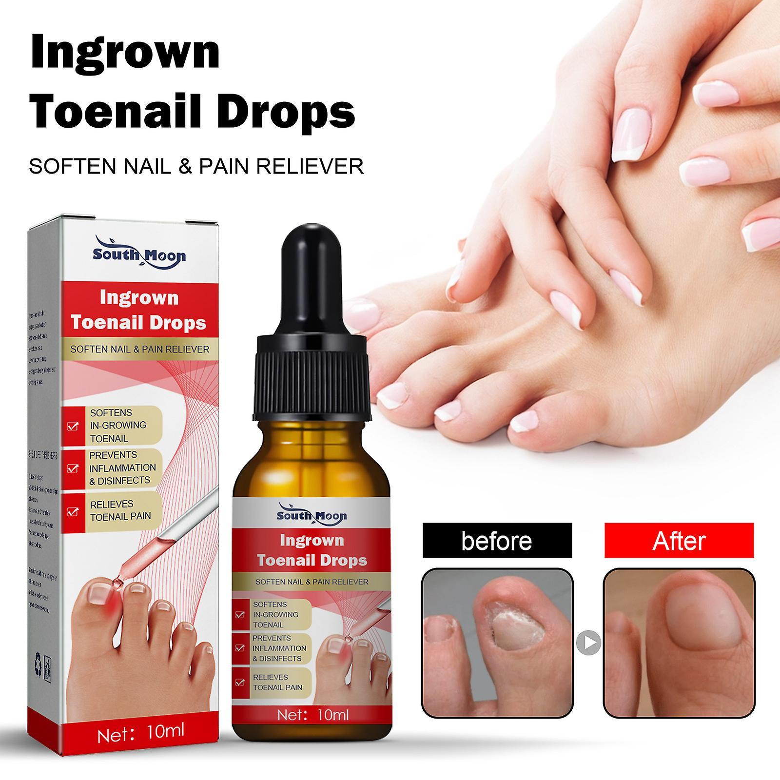 Aiducho 30ml Ingrown Toenail Treatment,nail Growth Treatment,ingrown Toenail Drops Cuticle Nail Oil Ingrown Toenail Correction 2pcs