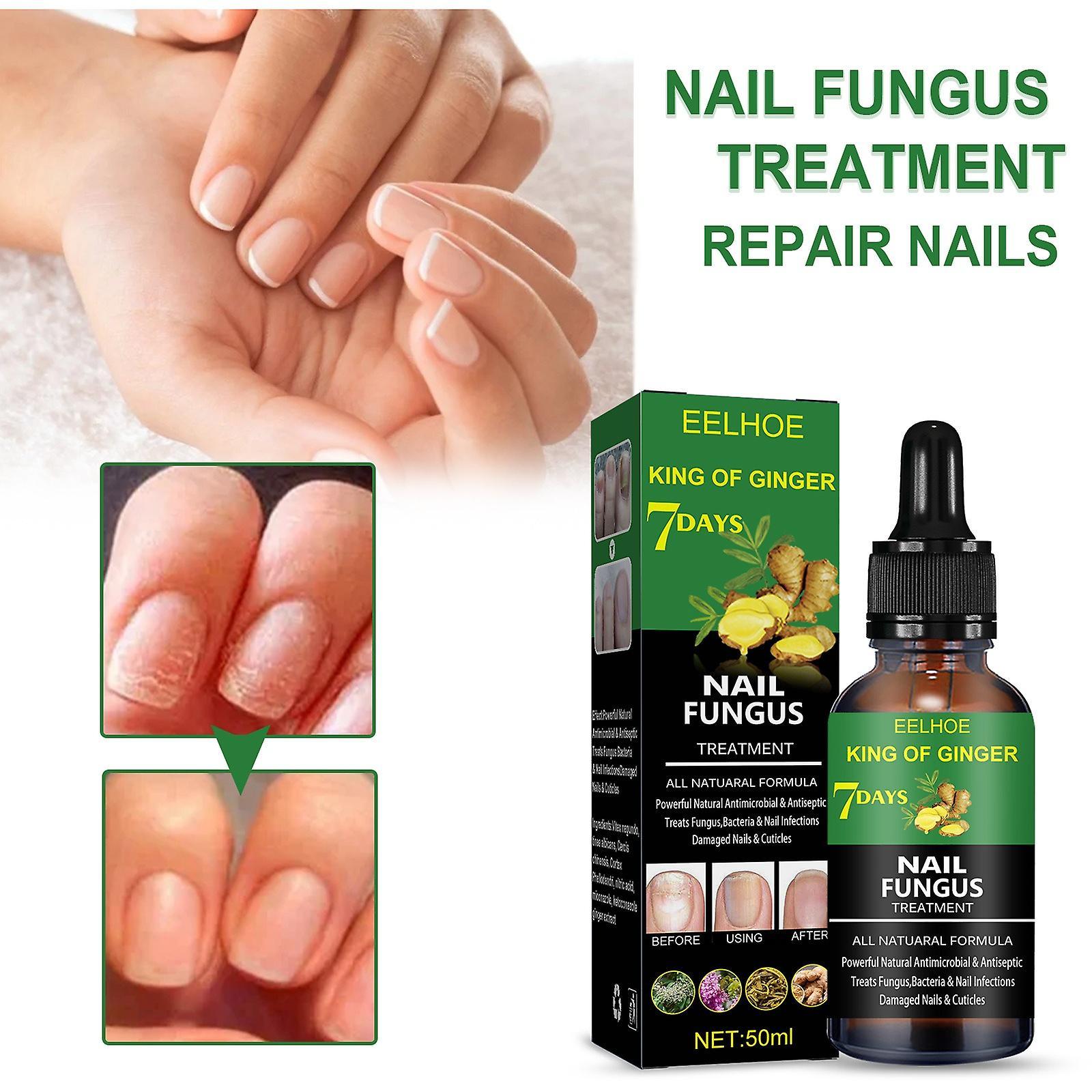 Frusde Toenail Fungus Treatment, Nails Fungus Treatment, 50ml Extra Strength Nail Repair Solution For Fingers And Toenails, Nail Care Oil 1pcs