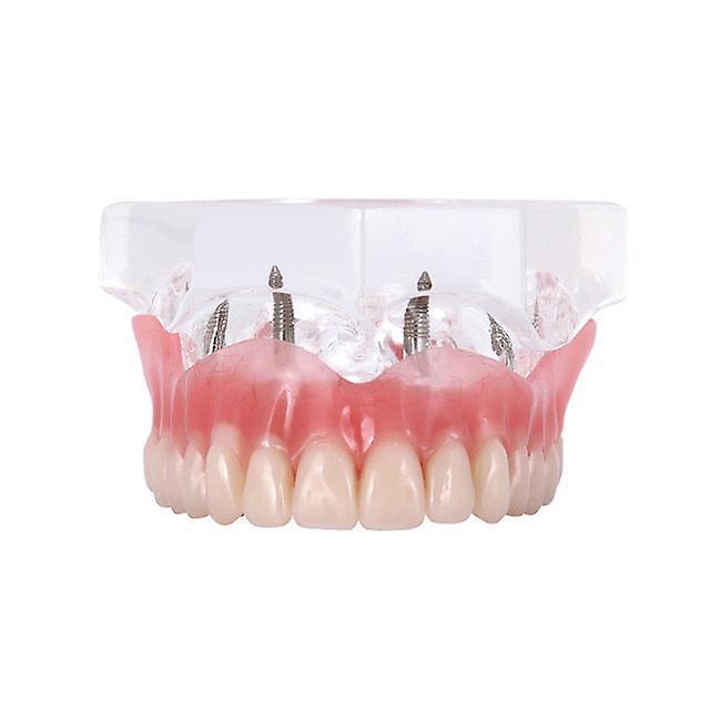 Slowmoose Dental Implant Restoration Teeth Model With Restoration Bridge M6001X