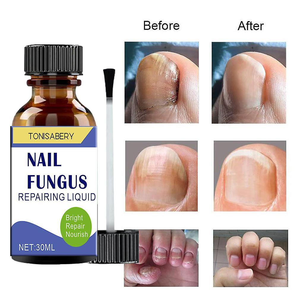 Antbaba Fungal Nail Treatment, Extra Strong Nail Fungus Treatment for Toenail, Nail Repair Solution for Toenail or Fingernail Nail Anti Fungus Nail...