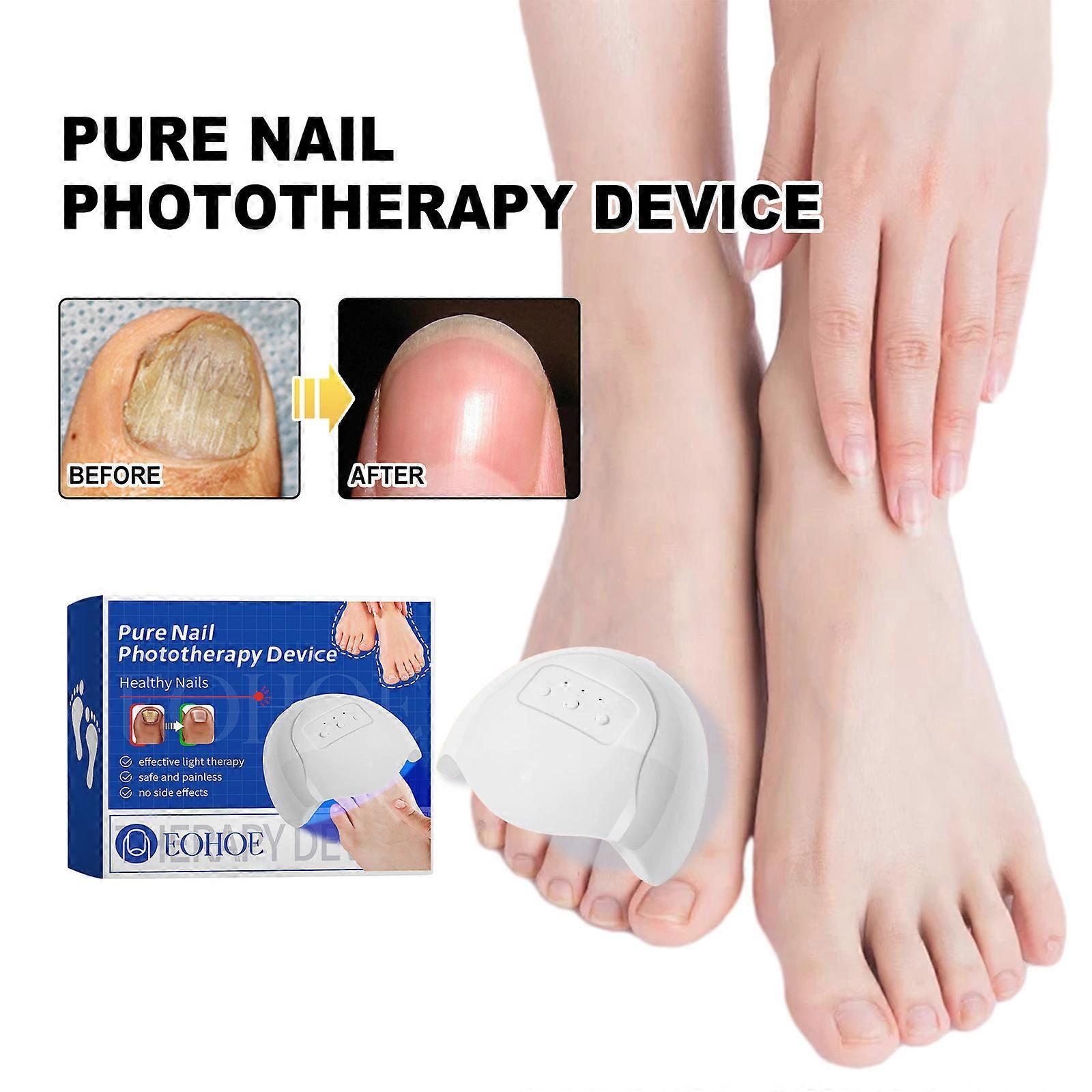 Unbrand Purenail Fungus Laser Therapy Device, Pure Nail Phototherapy Device, Nail Fungus Laser Treatment Device, Nail Fungus Laser Treatment White