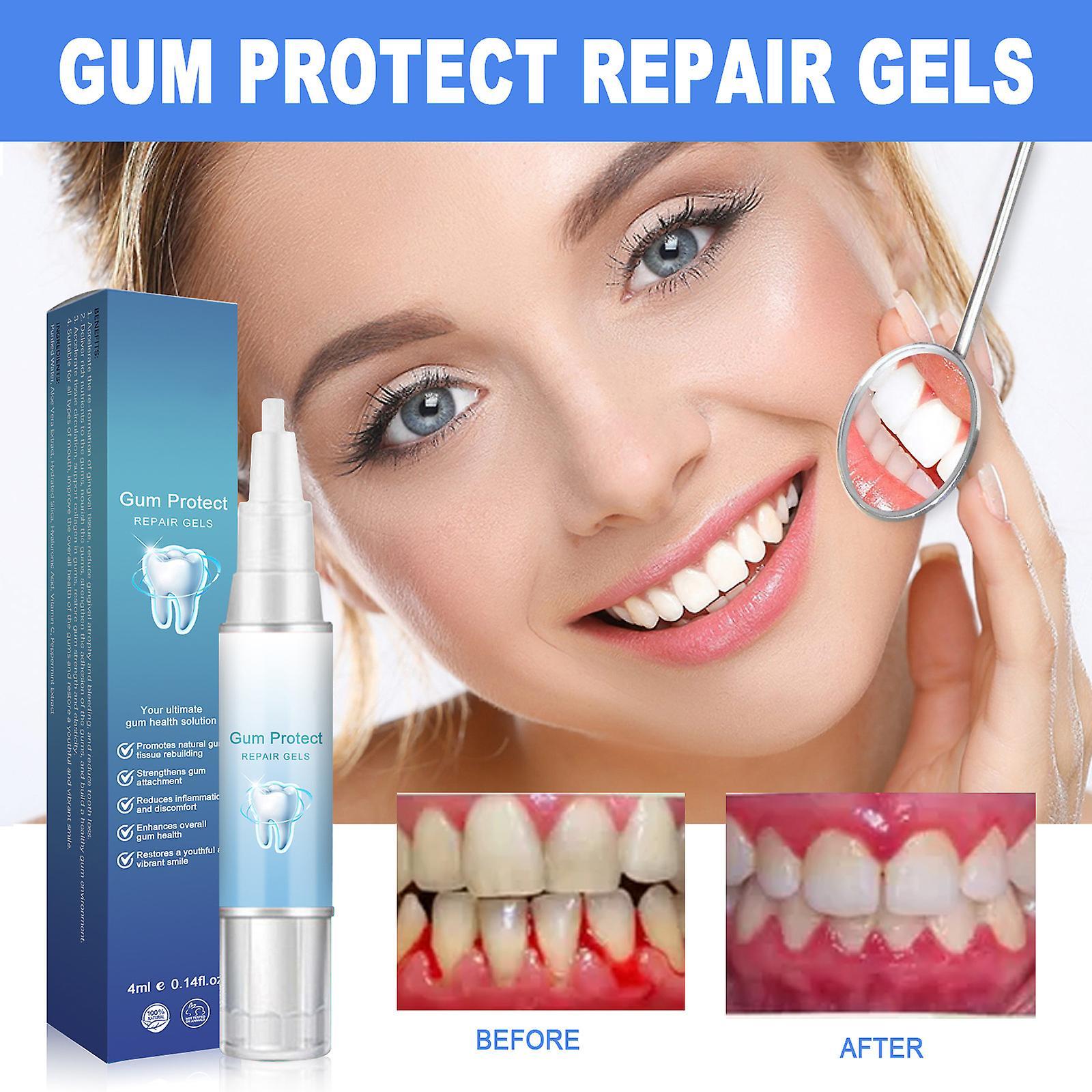 Fongwan Gum Shield Therapy Gel, Instant Gum Repair Treatment Gel Teeth Whitening Essence Pen, Oral Care Gum Regrowth Gel Restore Gum Health 3pcs - ...